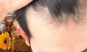 You can't always prevent hair loss in men, but you can learn more about how to reduce or prevent hair loss. Hair Loss Treatment The Natural Product Shown To Stimulate Hair Follicles Into Action Sound Health And Lasting Wealth