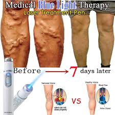 1pc Medical Blue Light Therapy Laser Treatment Pen Soft Scar Wrinkle Removal Treatment Device Remove Varicose Veins Laser Pen Wish
