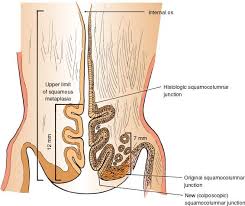 There is a distinct junction between the two cell types called the transformation zone. Cervical Cancer Screening And Preinvasive Disease Oncohema Key