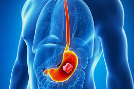 When signs and symptoms aren't apparent or go ignored, the disease generally reaches more advanced stages before being properly diagnosed. 8 Warning Signs Of Stomach Cancer Geelong Medical Health Group