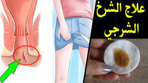 علاج فعال للشق الشرجي في غضون ايام قليلة سيختفي الشرخ الشرجي للأبد youtube