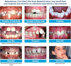 How do braces can fix a crossbite? Early Phase 1 Treatment