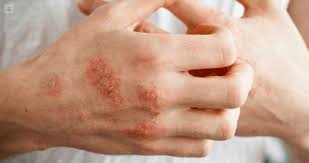Image result for dermatitis contacta