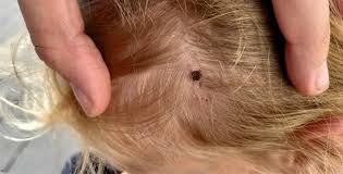Image result for infected tick bite