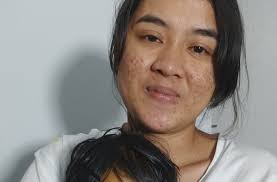 PPTSB Pastikan Pdt Andreas Sinaga Butuh Donasi untuk Transpalasi Hati Putri  Karen Uly Gregoria Sinaga