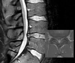 Check spelling or type a new query. Spontaneous Resorption Of Herniated Disc Does It Happen