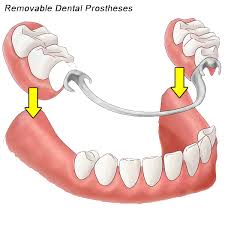 Image result for dentures