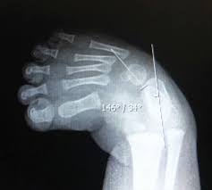 Clubfoot is a congenital deformity found in infants that results in the heel and toes treatments for clubfoot aim for a fully functioning, painless foot with little to no deformity present. Radiological Study Of Anatomical Bony Arrangement Of The Clubfoot Deformity And Its Correlation With The Pirani Clinical Scoring System A Multicenter Study Abstract Europe Pmc