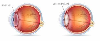 Image result for Cataract Extraction