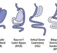 What is Bariatric Surgery?