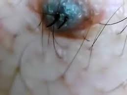 1674 x 932 png 2301 кб. The World S Longest Ingrown Hairs Removal Youtube