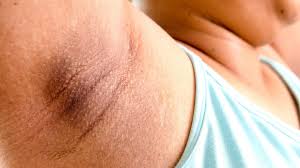 Cara menghilangkan ketiak hitam dan berbulu. 10 Penyebab Kulit Ketiak Berwarna Hitam Apa Saja