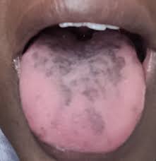 Image result for brown tongue symptoms