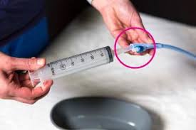 Image result for Bladder Irrigation