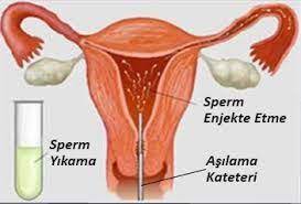 Neden Cocugum Olmuyor Doc Dr Yavuz Simsek Kadin Sagligi Merkezi Kadin Sagligi Kadin Doga
