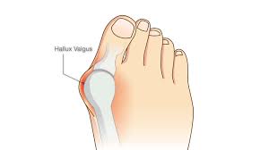 It's an easy way to strengthen foot and toe muscles, and it gives your feet a gentle massage. Yoga For Bunions