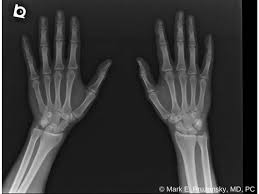 Image result for Scaphoid Bone