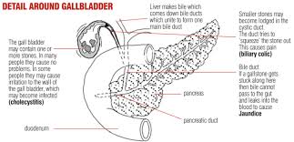 How do i know if i have a more complicated test may be used if the doctor suspects that a gallstone is lodged in a bile duct. Gallstones Symptoms Causes Treatment Guts Uk