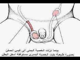 علاج الخصية المعلقة طرق طبيه للتخلص من عدم الانجاب احلى حلوات