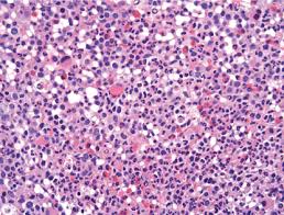 Answers To Hematology Expert Review Questions The Asco Post