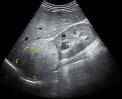 Urology Rbh September 2011 Ultrasound Sonography Ultrasound Technician Ultrasound