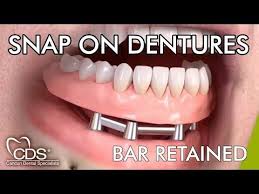 Snap On Dentures Experts Over 5000 Retired Americans And Canadians Treated Cancun Dental Specialists Offers Snap On D Dental Specialist Dentures Mini Implants