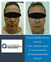 Lipotransferencia Facial Rejuvenecimiento Facial con grasa autologa. Dr  Alonso Ogarrio Díaz Master Medicina Estética y Antienvejecimiento  #medicinaestetica #microliposuction #aesthetic 📆 Agenda tu cita de  valoración ...