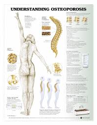 Calcium And Vitamin D Combination To Reduce Osteoporosis Risk Osteoporosis Osteoporosis Diet Bone Health