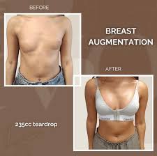 Image result for Breast Augmentation