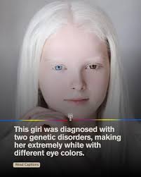 Rare but beautiful heterochromia 🌻