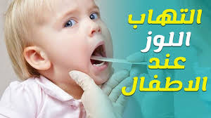 Ø¹Ù„Ø§Ø¬ Ø§Ù„ØªÙ‡Ø§Ø¨ Ø§Ù„Ù„ÙˆØ²ØªÙŠÙ† Ø¹Ù†Ø¯ Ø§Ù„Ø§Ø·ÙØ§Ù„ ÙÙŠ Ø§Ù„Ù…Ù†Ø²Ù„ Youtube