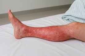 Image result for erysipel photos)