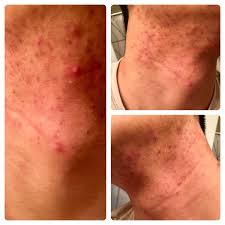 I stay away from dairy now. How To Treat Acne Scarring Discoloration On Face And Neck Been Reading About Microdermabrasion Chemical Peels Facials Etc I Think What I Have Is More Acne Hyperpigmentation Dark Marks Rather Than Actual Scarring Please