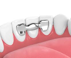 The maryland bridge is a bridge that crosses over the assiniboine river in winnipeg, manitoba. What Type Of Dental Bridge Is Right For Me Dental Care Of Lombard