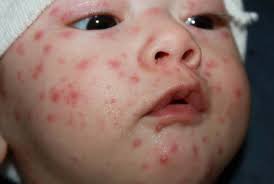 Akan tetapi tetap saja anda harus waspada, pasalnya virus varicella ini akan menetap di dalam tubuh. Mengenal Cacar Air Varisela Untuk Warga Rt 15 Rw 02 Kel Jepara Karang Taruana Mahameru Rt 15