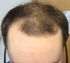 Propranolol hair loss and paxil and heart palpitations. Evaluation Of Hair Loss In A Primary Care Setting 2018 10 19 Relias Media Continuing Medical Education Publishing