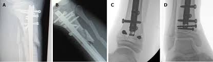 How much of nancy nail's work have you seen? Rigid Locked Nail Fixation For Pediatric Tibia Fractures Where Are The Data