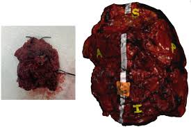Enhanced Intraoperative Communication of Tumor Margins Using 3D Scanning  and Mapping: The Computer-Aided Design Margin.