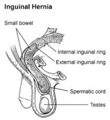 A surgical procedure in which an incision, or cut, is made in the groin. Icd 10 Hernia Scrotalis Berbagi Informasi