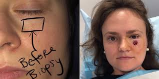 early signs skin cancer photos; Skin Cancer Woman Discovers Basal Cell Carcinoma Near Eye