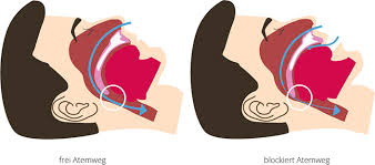 Schlafapnoe Ursachen Symptome Einfluss Auf Das Herz Cardiosecur
