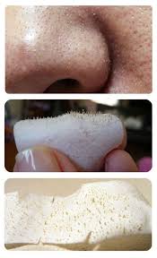 Remove the pot from the burner. How To Remove Deep Blackheads Skin Care Deep Blackheads Blackheads Body Care