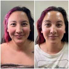 Laser therapy for BMS: typical session count?