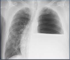 Image result for Succussion Splash