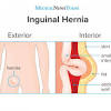 Lymph nodes are small organs, size of which measures cervical lymph nodes are present in the neck region. 1