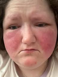 Hi I'm new here! I been gluten intolerant for more than 10 years however  the doctor thinks I've got coeliac. so I have to have gluten for the next  three months only