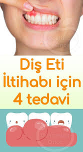 Dis Eti Iltihabi Icin 4 Dogal Tedavi Yontemi Dogal Tedaviler Dogal Dis Beyazlatma Dogal