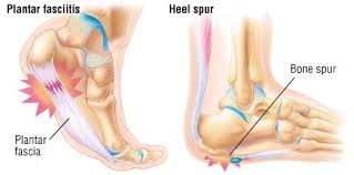 If you have pain on the bottom of your foot, you should see your doctor or physical therapist before starting any treatment for your condition. Heel Pain Guide Causes Symptoms And Treatment Options