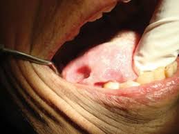 Image result for cancer of tongue