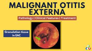 Image result for Necrotizing Otitis Externa